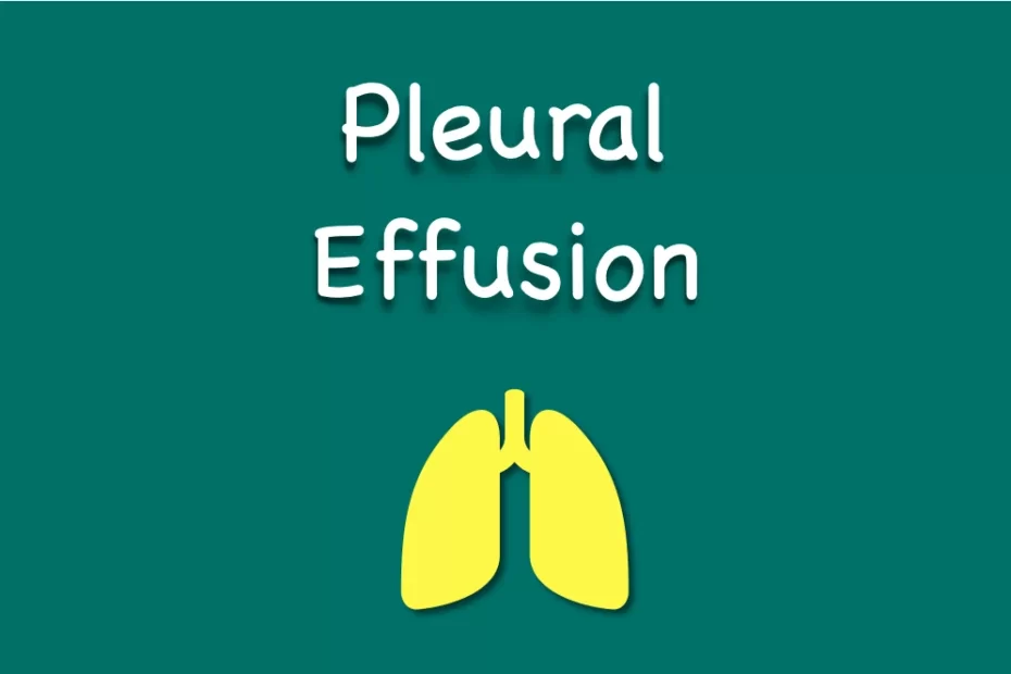 Pleural-effusion